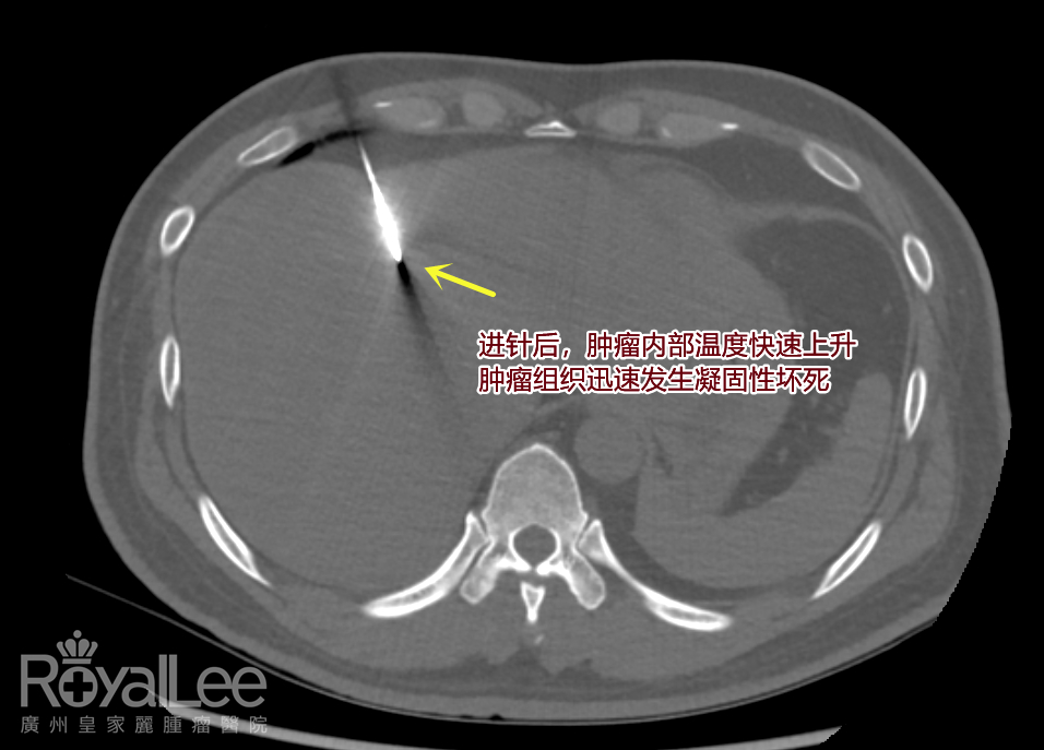 After the needle is inserted, the temperature inside the tumor rises rapidly, and coagulation necrosis occurs rapidly in the tumor tissue