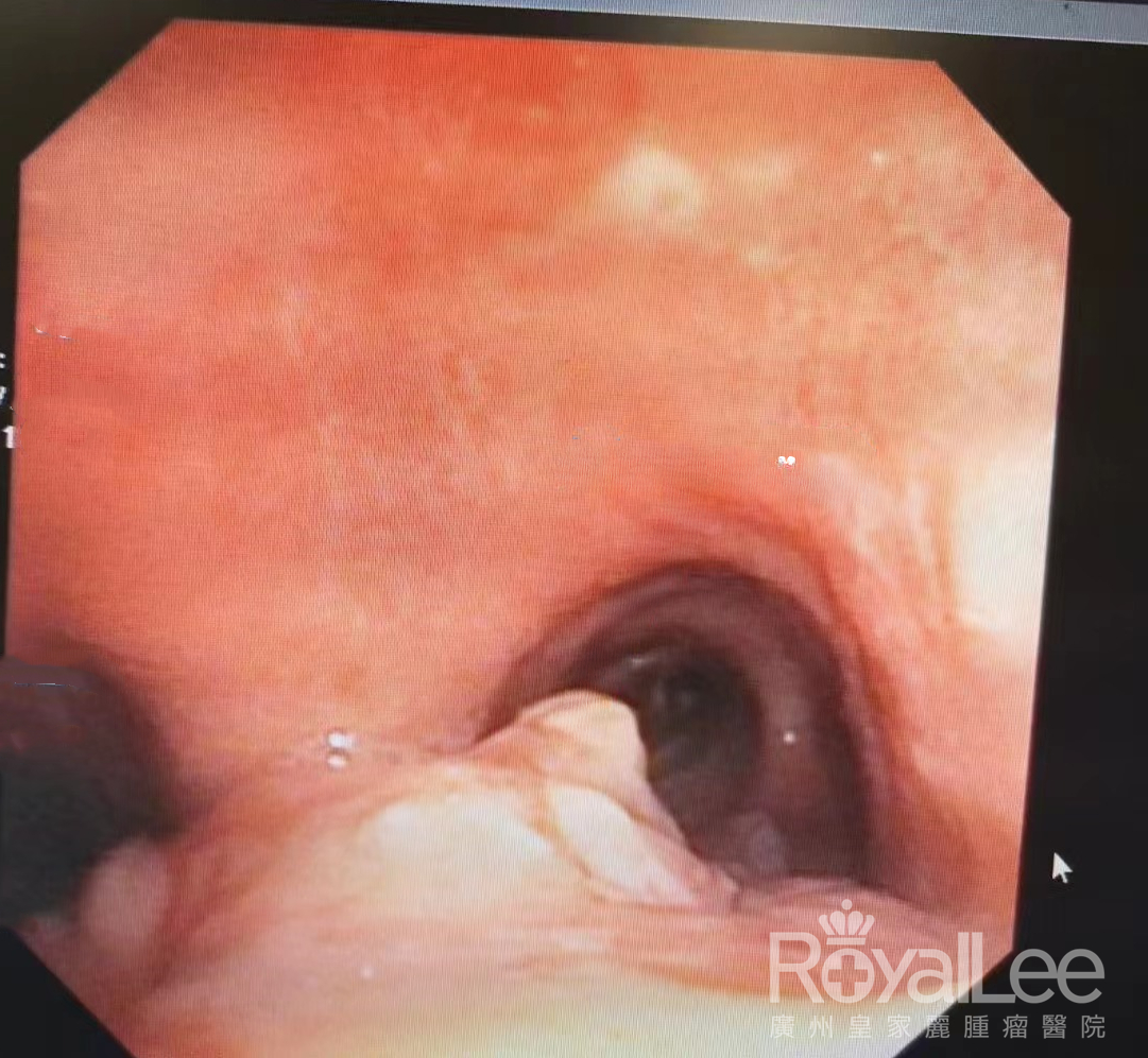 Mass on the Right Main Bronchus