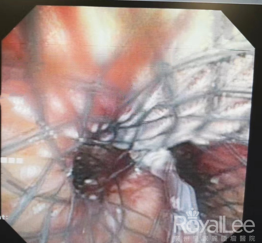  Placement of a Peritoneal Y-shaped Stent to Restore Tracheal Patency