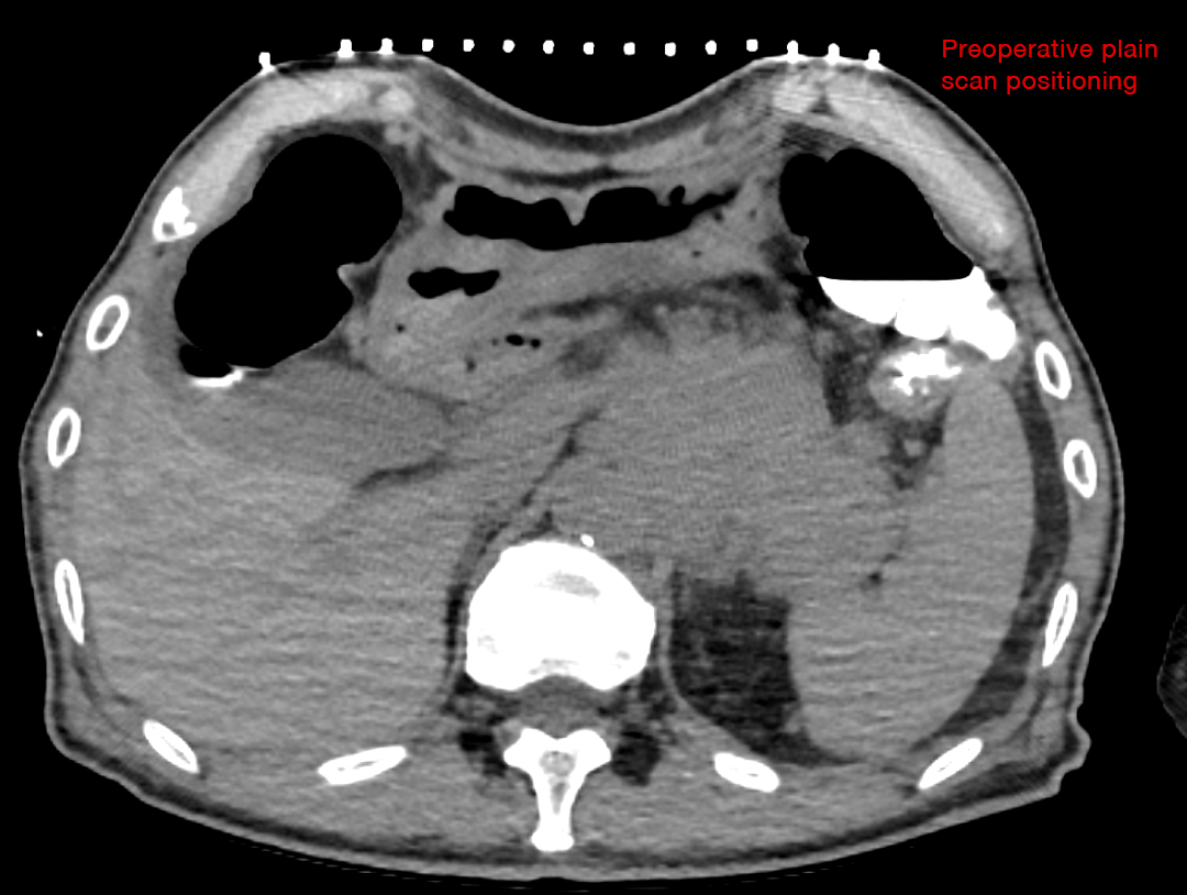 Preoperative plain scan positioning