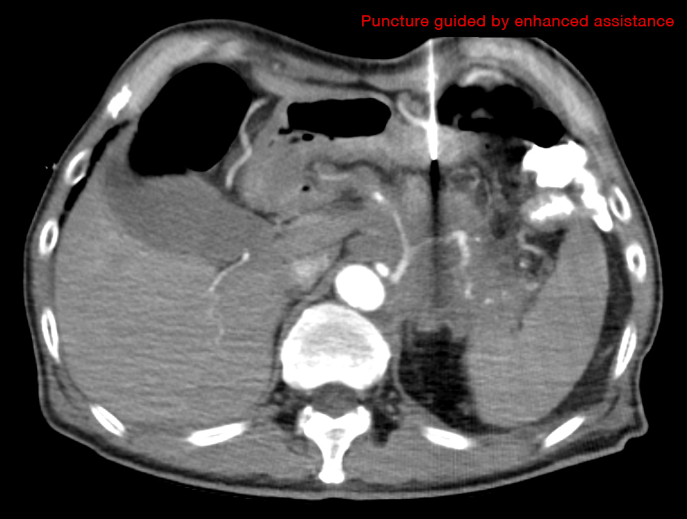 Puncture guided by enhanced assistance