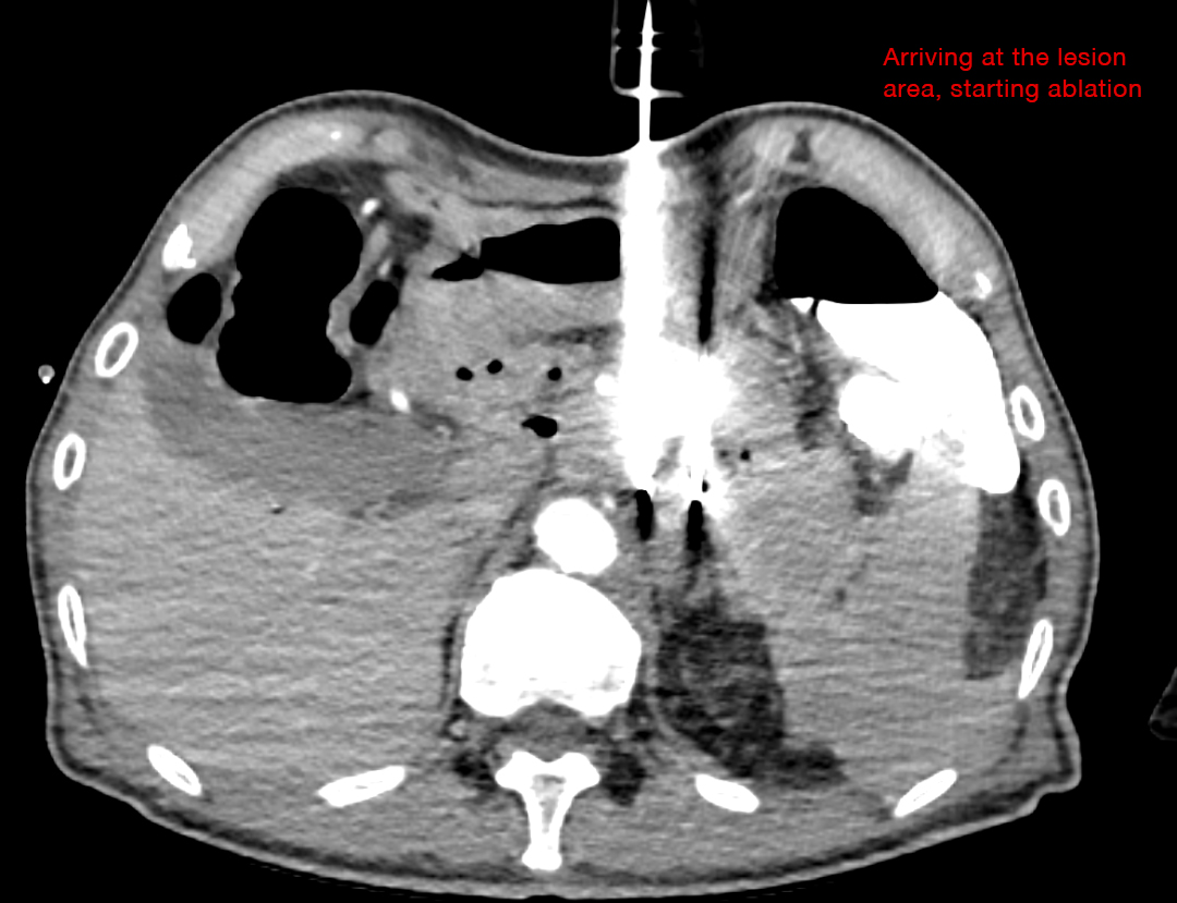 Arriving at the lesion area, starting ablation